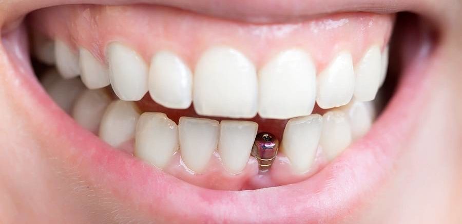 implant dentar chisinau